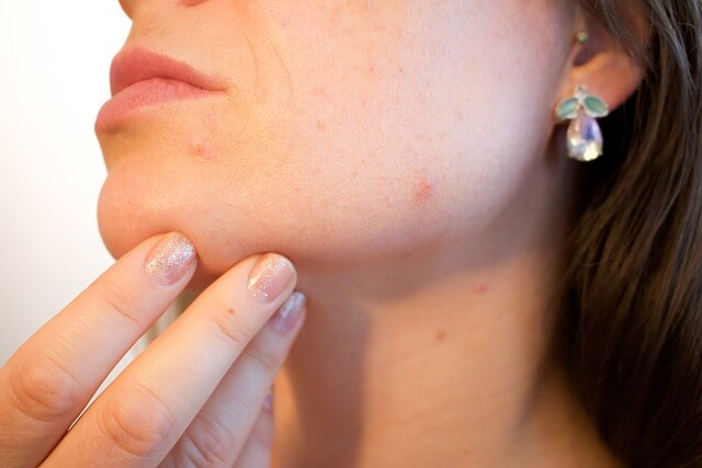 acne-1606765_640 (1)